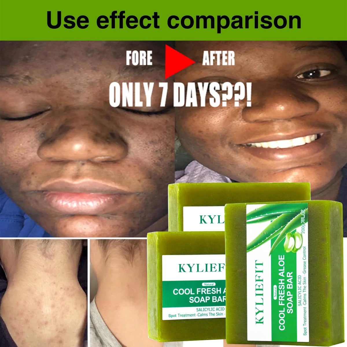 AILKE Aloe Vera Soap For Acne And Dark Spot Care